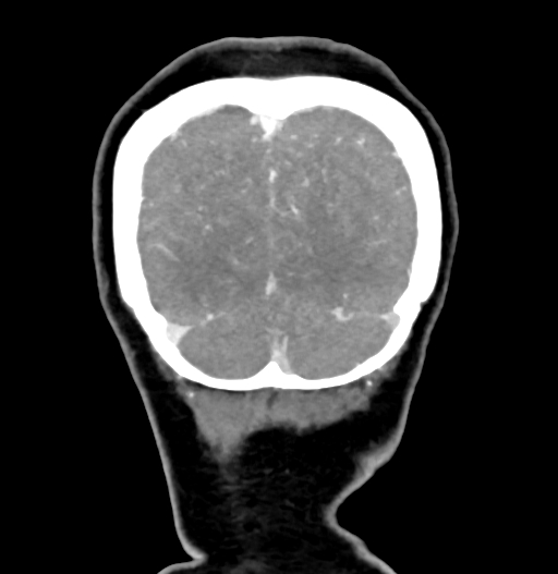 Cerebral arteriovenous malformation (Radiopaedia 73830-84645 C 86).jpg