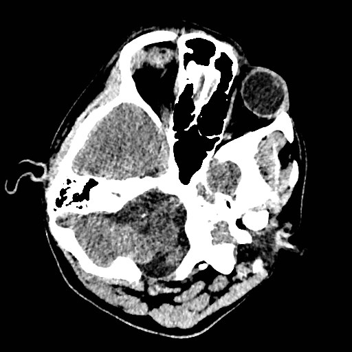 Cerebral arteriovenous malformation (Radiopaedia 79677-92887 Axial non-contrast 5).jpg