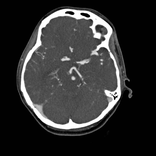 File:Cerebral arteriovenous malformation (Radiopaedia 79677-92888 A 18).jpg