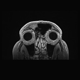 Cerebral arteriovenous malformation (Radiopaedia 84015-99245 Coronal T1 C+ 18).jpg