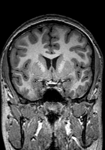 Cerebral arteriovenous malformation at posterior body of corpus callosum (Radiopaedia 74111-84925 Coronal T1 124).jpg