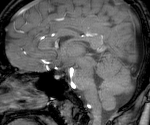 Cerebral arteriovenous malformation at posterior body of corpus callosum (Radiopaedia 74111-84925 J 191).jpg