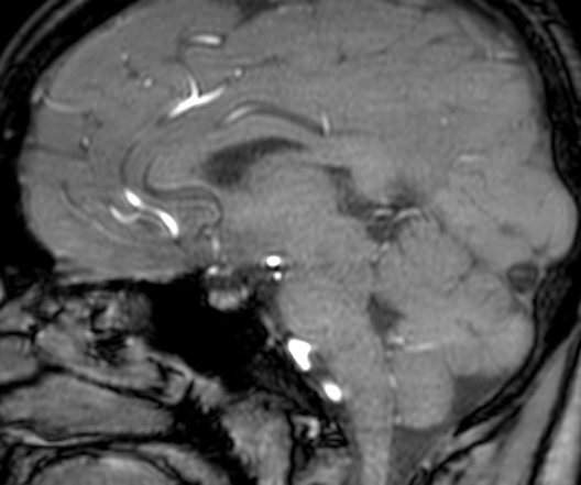 Cerebral arteriovenous malformation at posterior body of corpus callosum (Radiopaedia 74111-84925 J 206).jpg