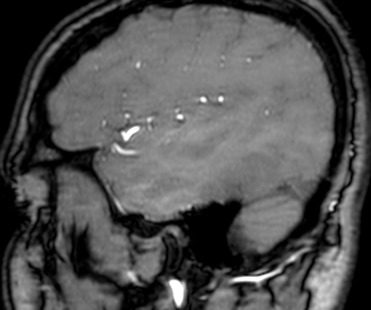 Cerebral arteriovenous malformation at posterior body of corpus callosum (Radiopaedia 74111-84925 J 336).jpg