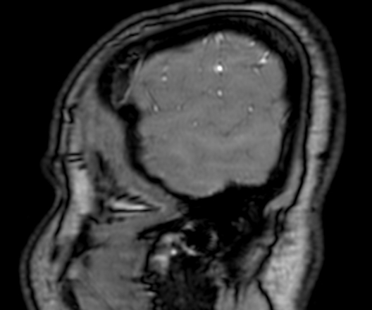 Cerebral arteriovenous malformation at posterior body of corpus callosum (Radiopaedia 74111-84925 J 8).jpg
