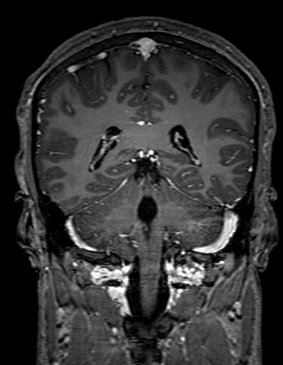 Cerebral arteriovenous malformation at posterior body of corpus callosum (Radiopaedia 74111-84925 K 244).jpg