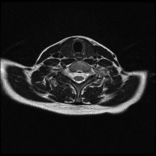 File:Cerebral autosomal dominant arteriopathy with subcortical infarcts and leukoencephalopathy (CADASIL) (Radiopaedia 41018-43763 Ax T2 C2-T1 49).png