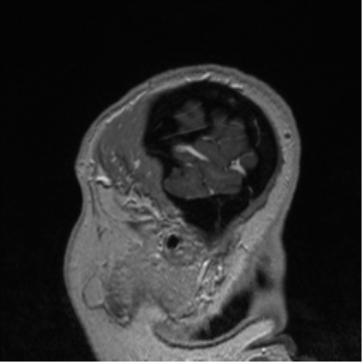 Cerebral cavernoma and development venous anomaly (Radiopaedia 37603-39482 Sagittal T1 C+ 12).png