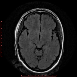 File:Cerebral cavernous malformation (Radiopaedia 26177-26306 FLAIR 10).jpg