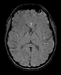 Cerebral cavernous venous malformation (Radiopaedia 70008-80021 I 39).jpg