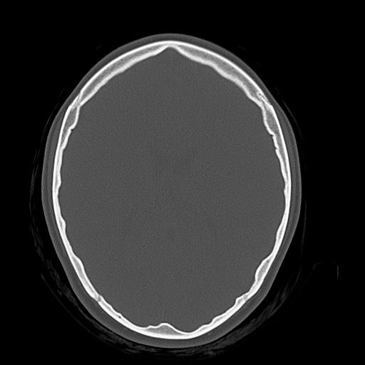 Cerebral cavernous venous malformation (Radiopaedia 70008-80022 Axial bone window 30).jpg