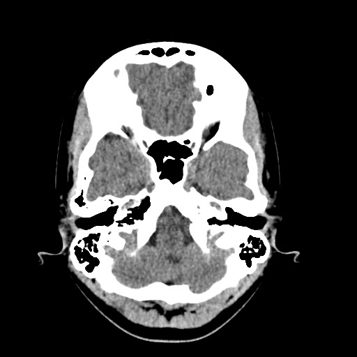 File:Cerebral cavernous venous malformation (Radiopaedia 70008-80022 Axial non-contrast 8).jpg