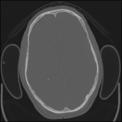 Cerebral contusions (Radiopaedia 33868-35039 Axial bone window 105).jpg