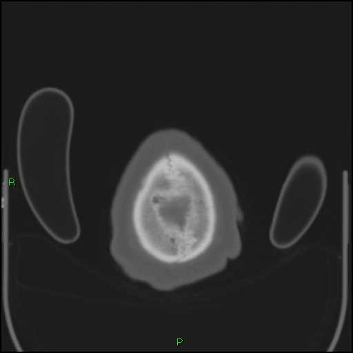 File:Cerebral contusions (Radiopaedia 33868-35039 Axial bone window 218).jpg
