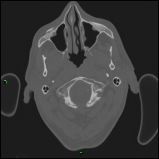 File:Cerebral contusions (Radiopaedia 33868-35039 Axial bone window 9).jpg