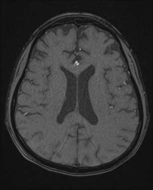 Cerebral embolic infarcts (embolic shower) (Radiopaedia 72391-82921 Axial MRA 120).jpg
