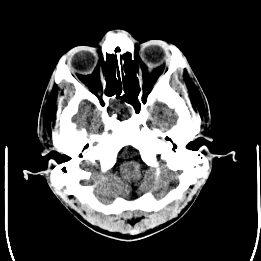 File:Cerebral hemorrhagic contusions- temporal evolution (Radiopaedia 40224-42756 Axial non-contrast 3).png