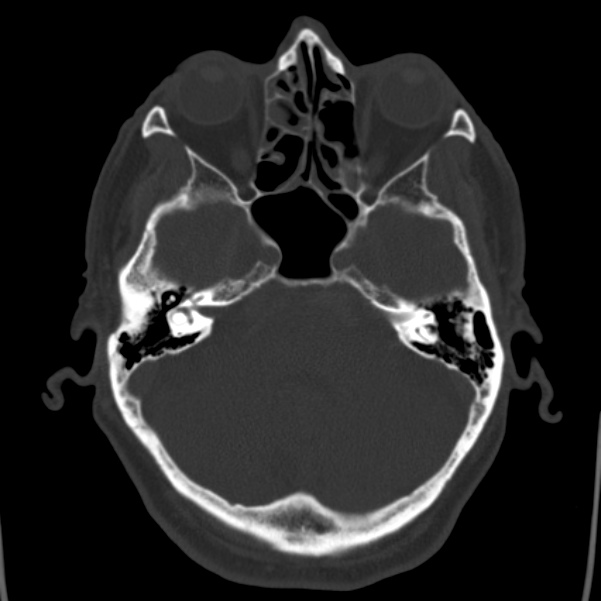Cerebral hemorrhagic contusions (Radiopaedia 23145-23188 Axial bone window 14).jpg