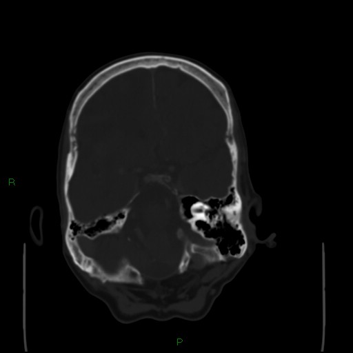 Cerebral metastases - breast primary (Radiopaedia 77653-89857 Axial bone window 36).jpg