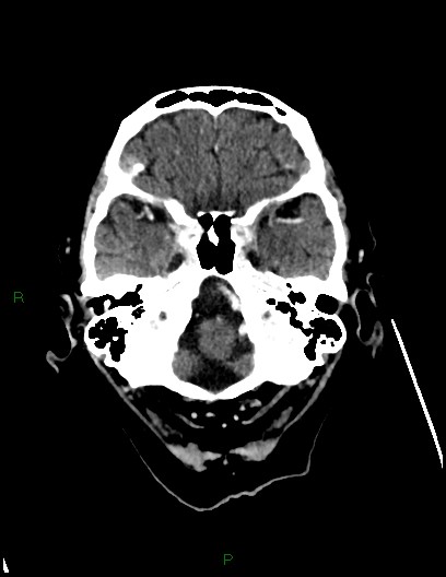 Cerebral metastases - ependymal and parenchymal (Radiopaedia 79877-93131 Axial C+ delayed 14).jpg