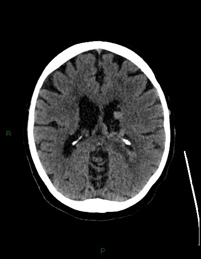 Cerebral metastases - ependymal and parenchymal (Radiopaedia 79877-93131 Axial non-contrast 43).jpg