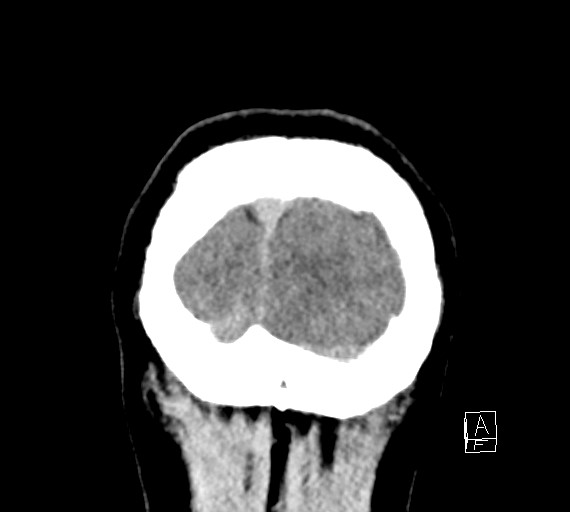Cerebral metastases - testicular choriocarcinoma (Radiopaedia 84486-99855 Coronal C+ delayed 59).jpg
