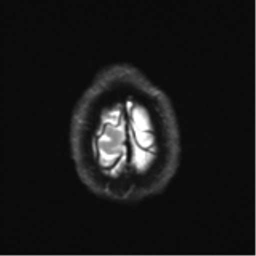 File:Cerebral metastasis - melanoma (Radiopaedia 54718-60954 Axial DWI 28).png