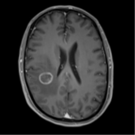 Cerebral metastasis - melanoma (Radiopaedia 54718-60954 Axial T1 C+ fat sat 33).png