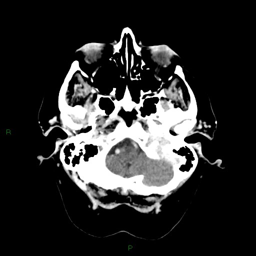 File:Cerebral metastasis from renal cell carcinoma (Radiopaedia 82306-96375 Axial C+ delayed 4).jpg