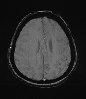 Cerebral metastasis to basal ganglia (Radiopaedia 81568-95413 Axial SWI 63).png