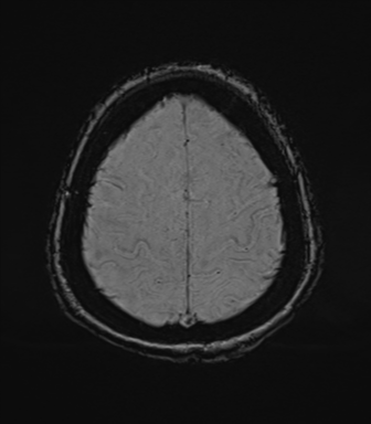 File:Cerebral metastasis to basal ganglia (Radiopaedia 81568-95413 Axial SWI 73).png