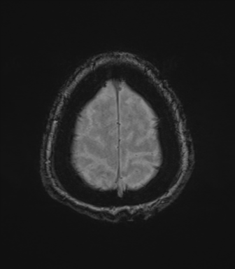 Cerebral metastasis to basal ganglia (Radiopaedia 81568-95413 Axial SWI magnitude 80).png