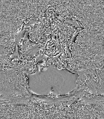Cerebral metastasis to basal ganglia (Radiopaedia 81568-95413 Axial SWI phase 10).png