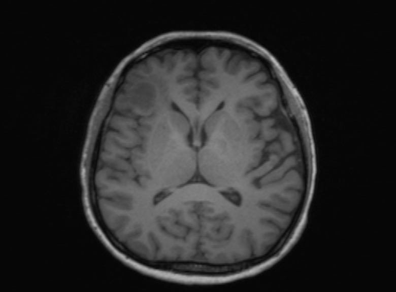 Cerebral ring enhancing lesions - cerebral metastases (Radiopaedia 44922-48817 Axial T1 218).jpg