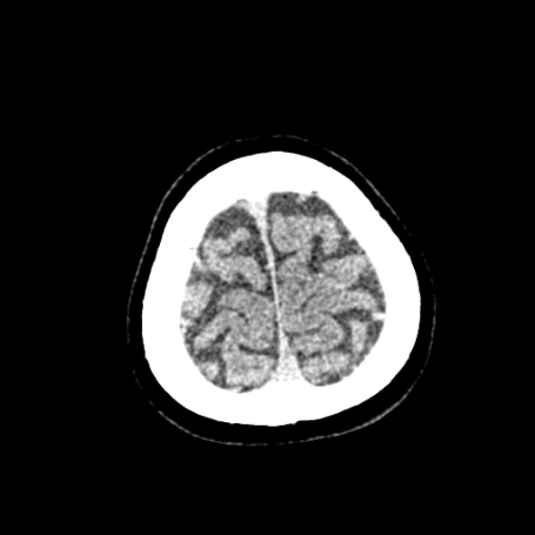 File:Cerebral ring enhancing lesions - cerebral metastases (Radiopaedia 44922-48818 Axial non-contrast 89).jpg