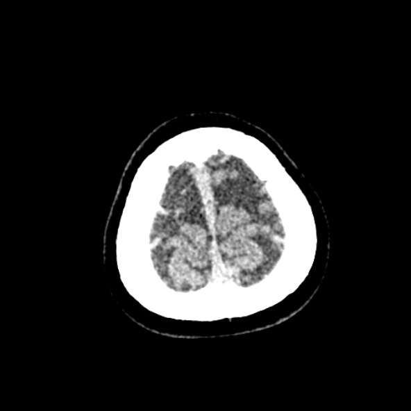 File:Cerebral ring enhancing lesions - cerebral metastases (Radiopaedia 44922-48818 Axial non-contrast 95).jpg