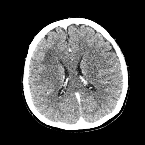 Cerebral ring enhancing lesions - cerebral metastases (Radiopaedia 44922-48818 B 174).jpg