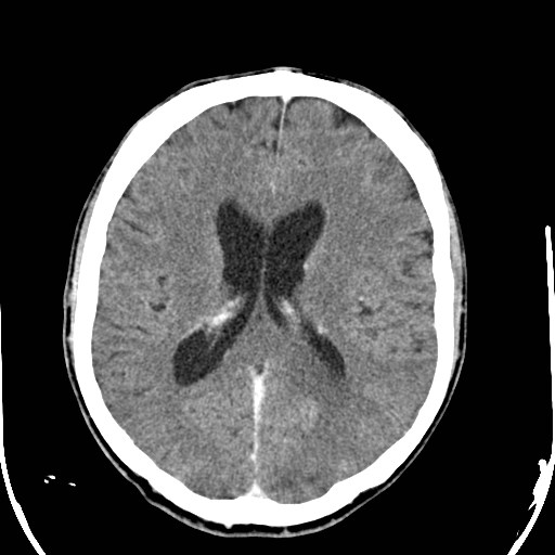 File:Cerebral toxoplasmosis (Radiopaedia 43956-47460 Axial C+ delayed 22).jpg