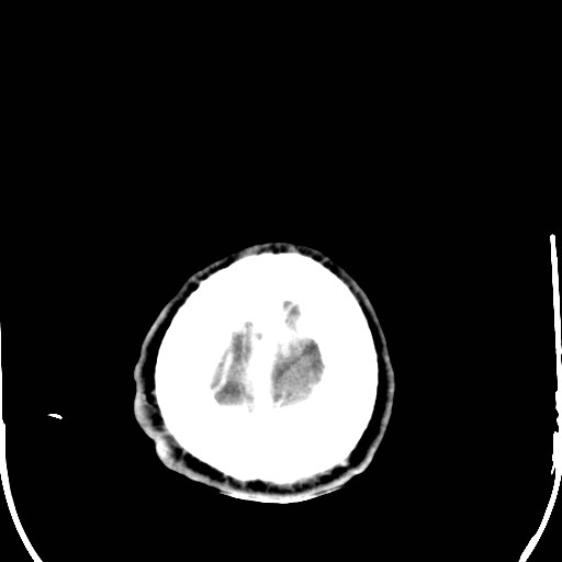 File:Cerebral toxoplasmosis (Radiopaedia 43956-47460 Axial C+ delayed 43).jpg
