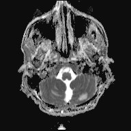 File:Cerebral toxoplasmosis (Radiopaedia 43956-47461 Axial ADC 2).jpg