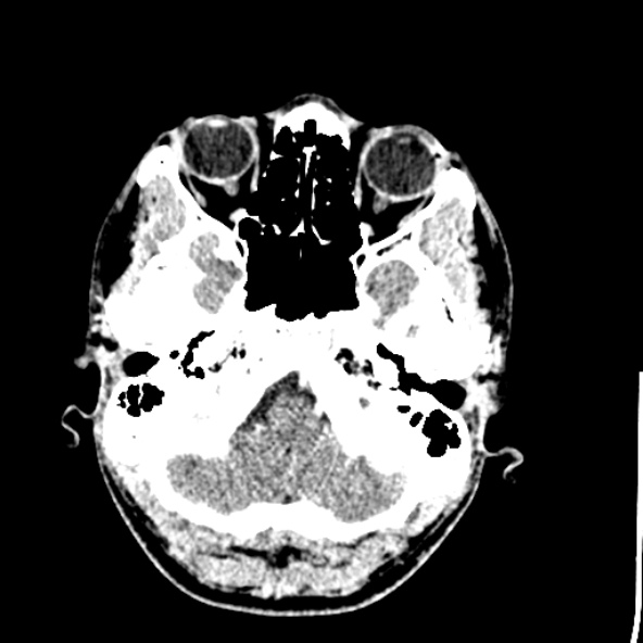 Cerebral toxoplasmosis (Radiopaedia 53993-60131 Axial C+ delayed 13).jpg