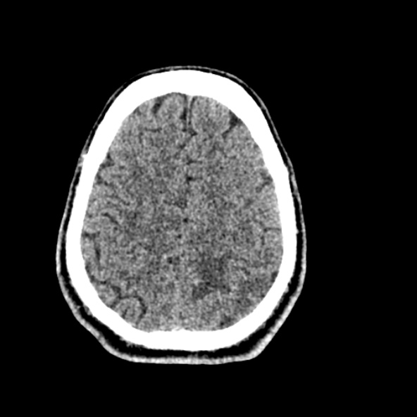 File:Cerebral toxoplasmosis (Radiopaedia 53993-60131 Axial non-contrast 63).jpg