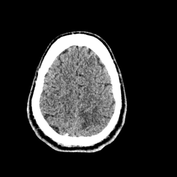 Cerebral toxoplasmosis (Radiopaedia 53993-60131 Axial non-contrast 66).jpg
