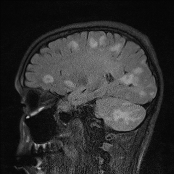 File:Cerebral toxoplasmosis (Radiopaedia 53993-60132 Sagittal FLAIR 10).jpg