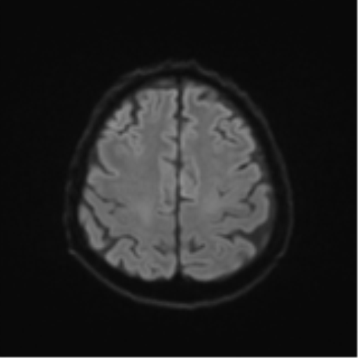 Cerebral toxoplasmosis (Radiopaedia 54575-60804 Axial DWI 57).png
