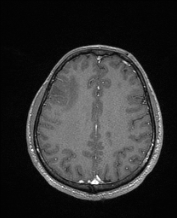 Cerebral toxoplasmosis (Radiopaedia 85779-101597 Axial T1 C+ 114).jpg