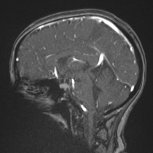 Cerebral venous infarction - hemorrhagic (Radiopaedia 81625-95505 Sagittal MRV 40).jpg
