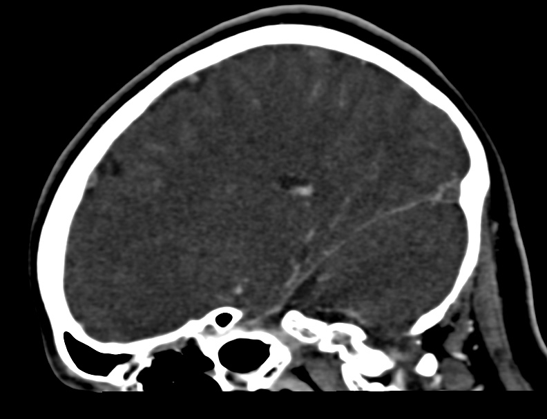 Cerebral venous sinus thrombosis (Radiopaedia 59224-66646 Sagittal C+ delayed 36).jpg