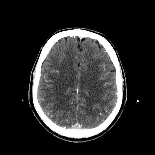 File:Cerebral venous thrombosis (CVT) (Radiopaedia 77524-89685 Axial with contrast 26).jpg