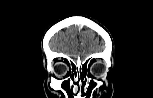 Cerebral venous thrombosis (CVT) (Radiopaedia 77524-89685 C 6).jpg